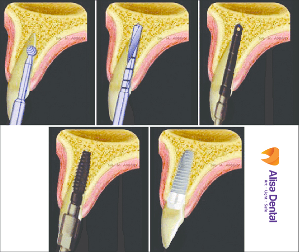 The dental implant process in Hanoi
