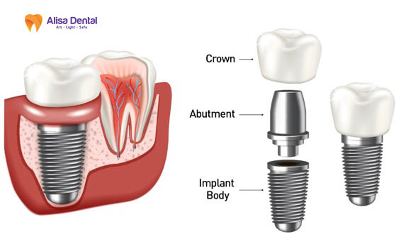 The structure of a dental implant post
