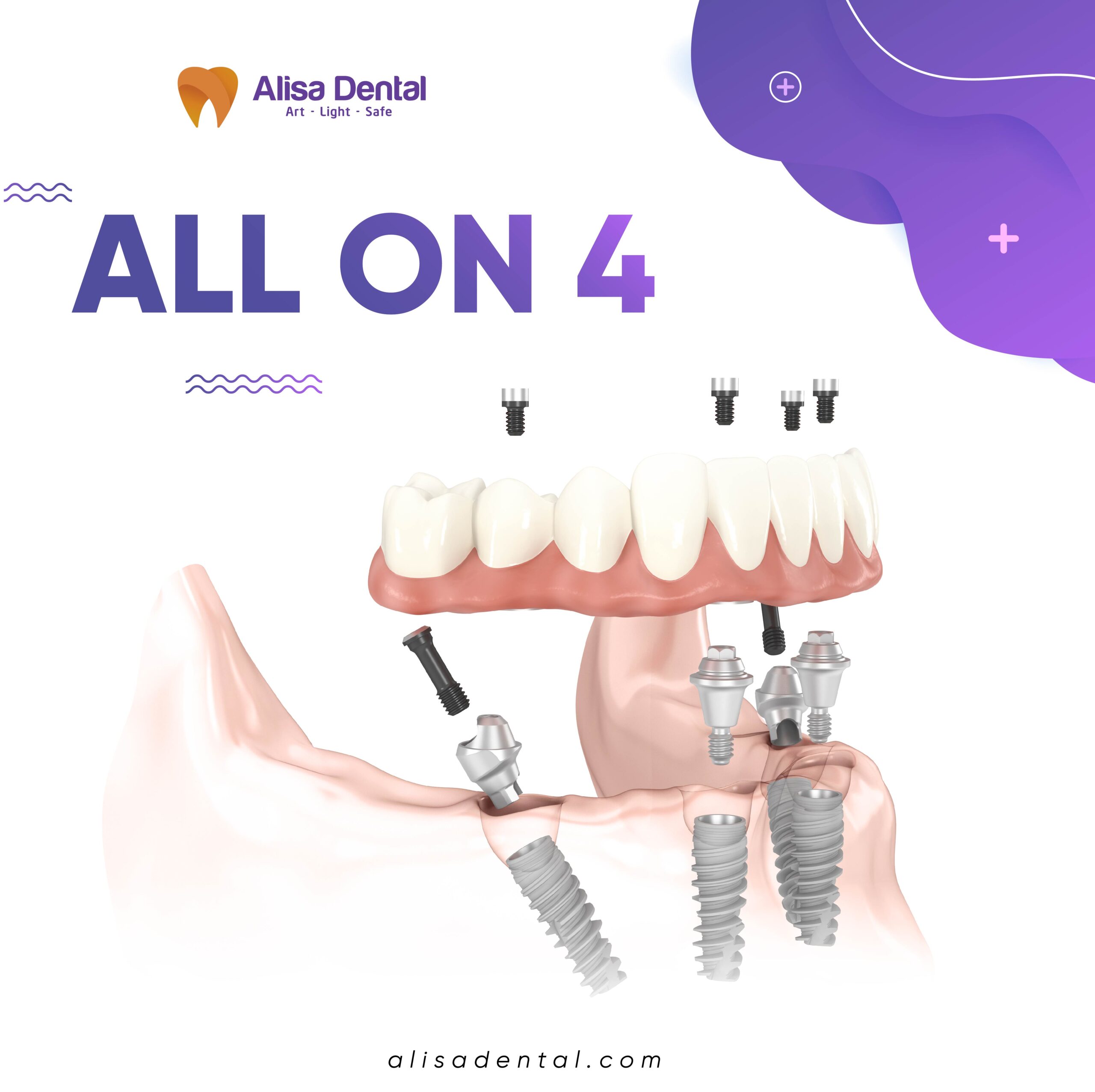 Looking for All-on-4 dental implants in Hanoi, Vietnam