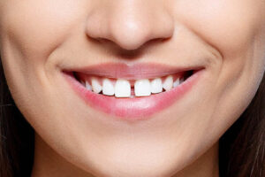 Closing the gaps in your smile with porcelain veneers