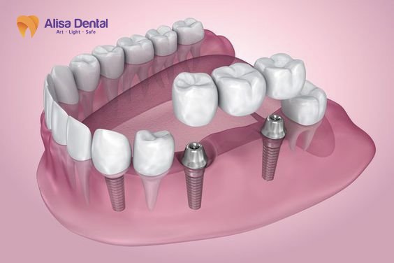 Implant-Supported Bridge