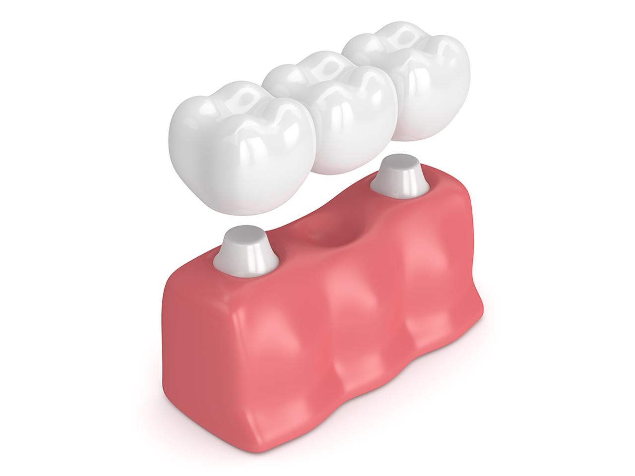Expert Dental Crown Services for Expatriates in Hanoi