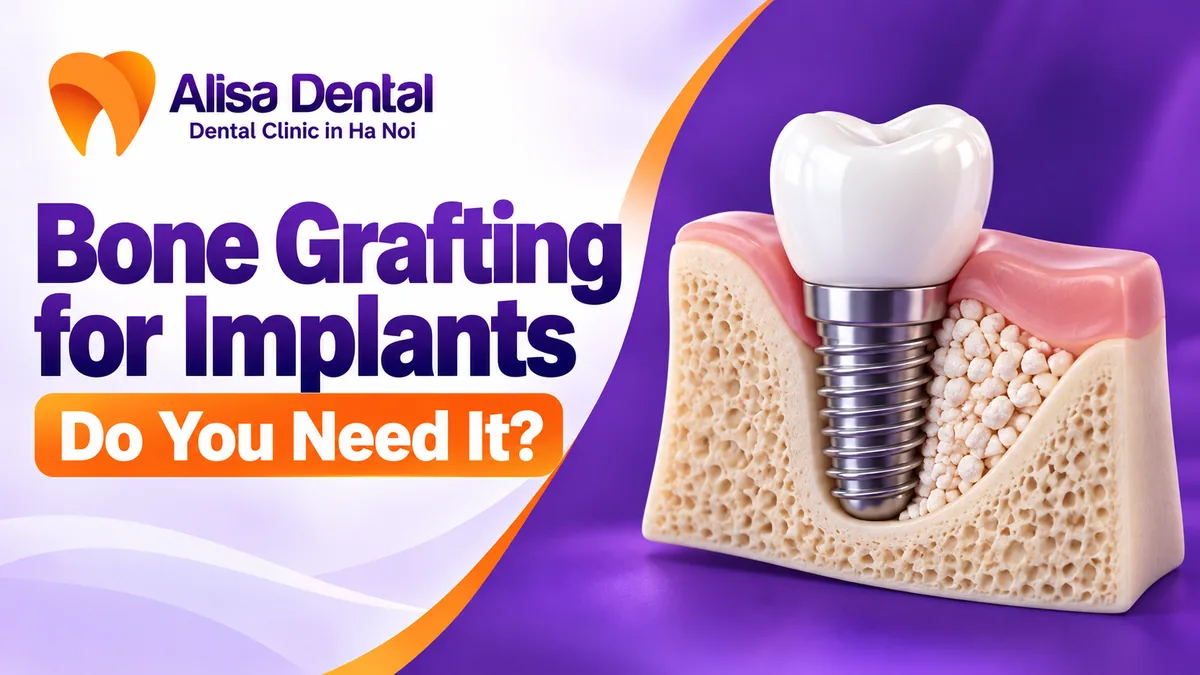 Conceptual illustration of a dental implant and bone graft for treatment planning in Hanoi